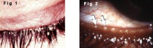 Blepharitis