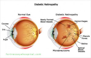 Diabetic-Retinopathy