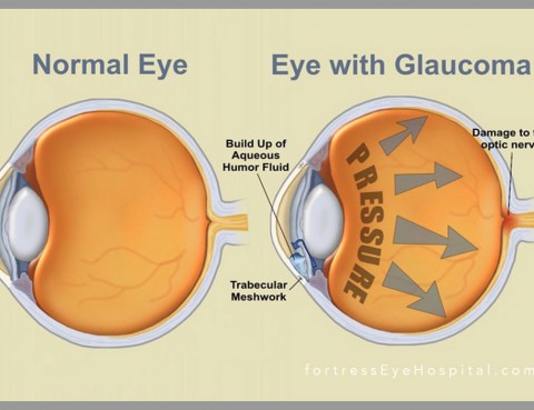 diabetes-and-eye-problem