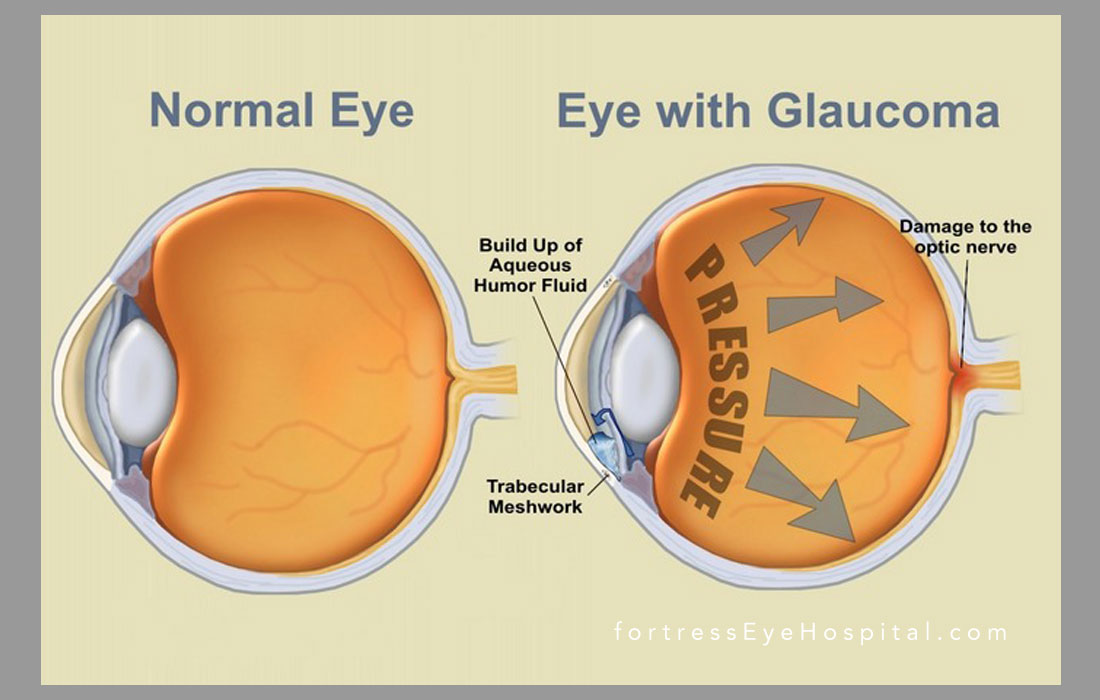 diabetes-and-eye-problem